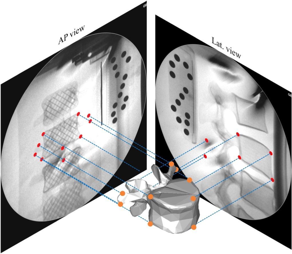 Reconstruction of three-dimensional lumbar vertebrae from biplanar x ...