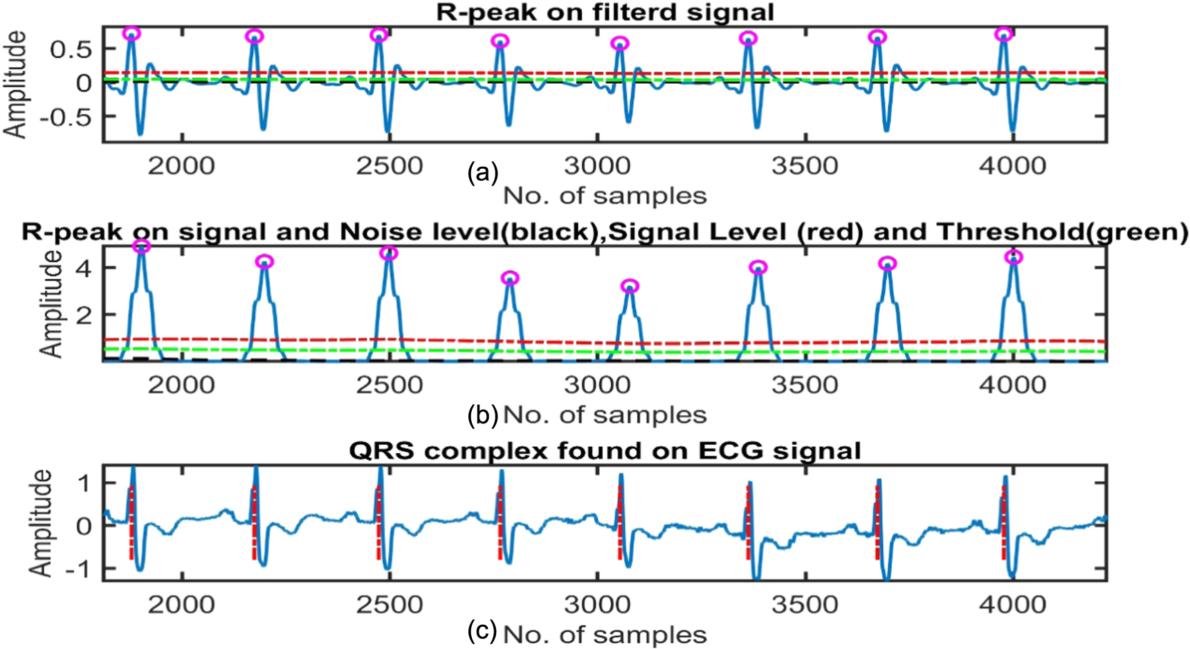 QRS complex detection using stationary wavelet transform and adaptive ...