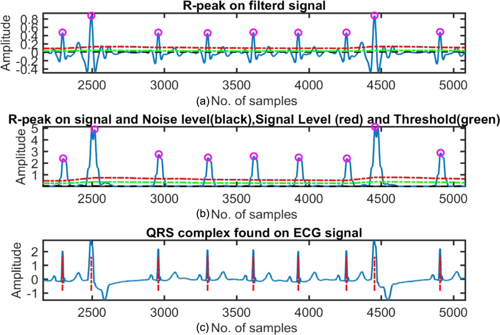 QRS complex detection using stationary wavelet transform and adaptive ...