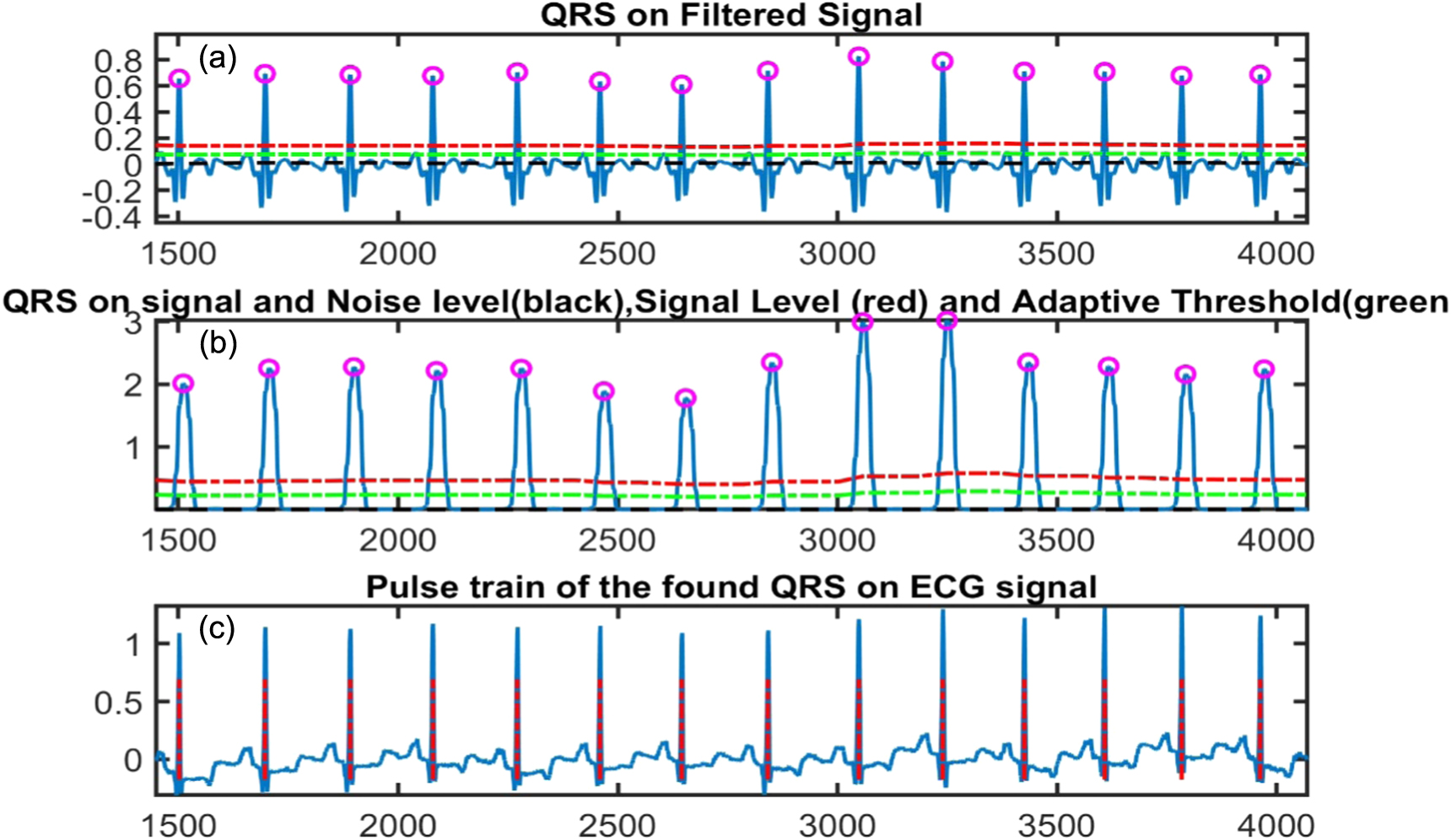 QRS complex detection using stationary wavelet transform and adaptive ...