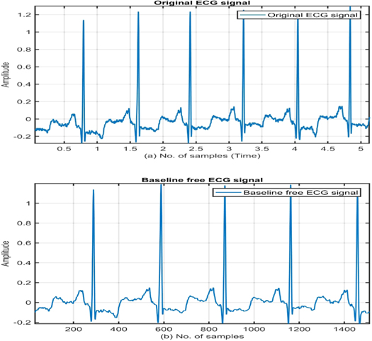QRS complex detection using stationary wavelet transform and adaptive ...