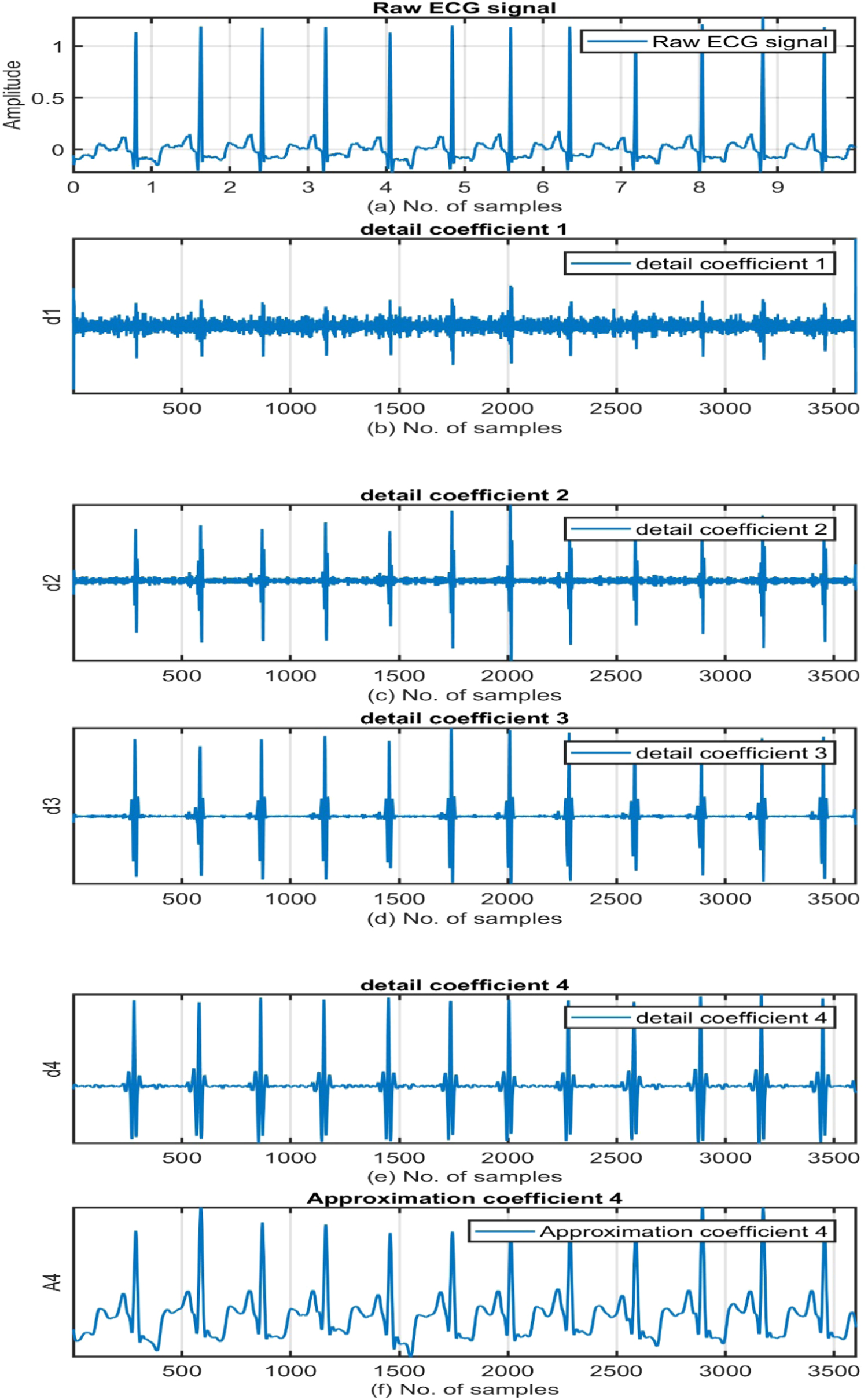 QRS complex detection using stationary wavelet transform and adaptive ...