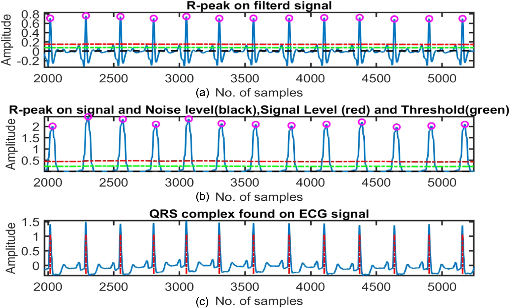 QRS complex detection using stationary wavelet transform and adaptive ...
