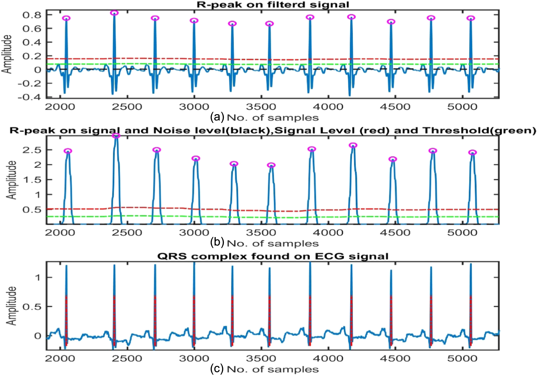 QRS complex detection using stationary wavelet transform and adaptive ...