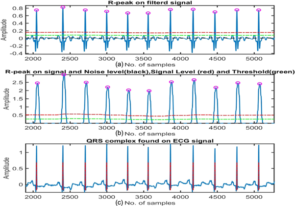 QRS complex detection using stationary wavelet transform and adaptive ...