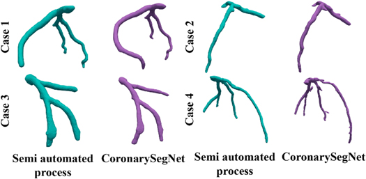 Segmenting 3D geometry of left coronary artery from coronary CT ...