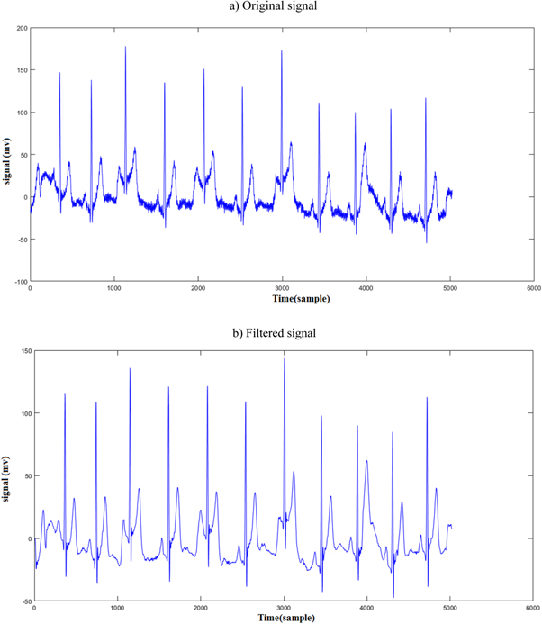 Classification of electrocardiogram signals using deep learning based ...
