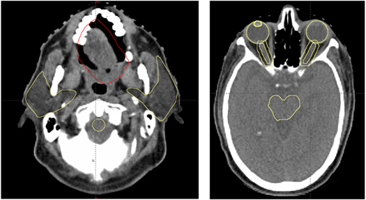 Generation of synthetic CT from CBCT using deep learning approaches for ...
