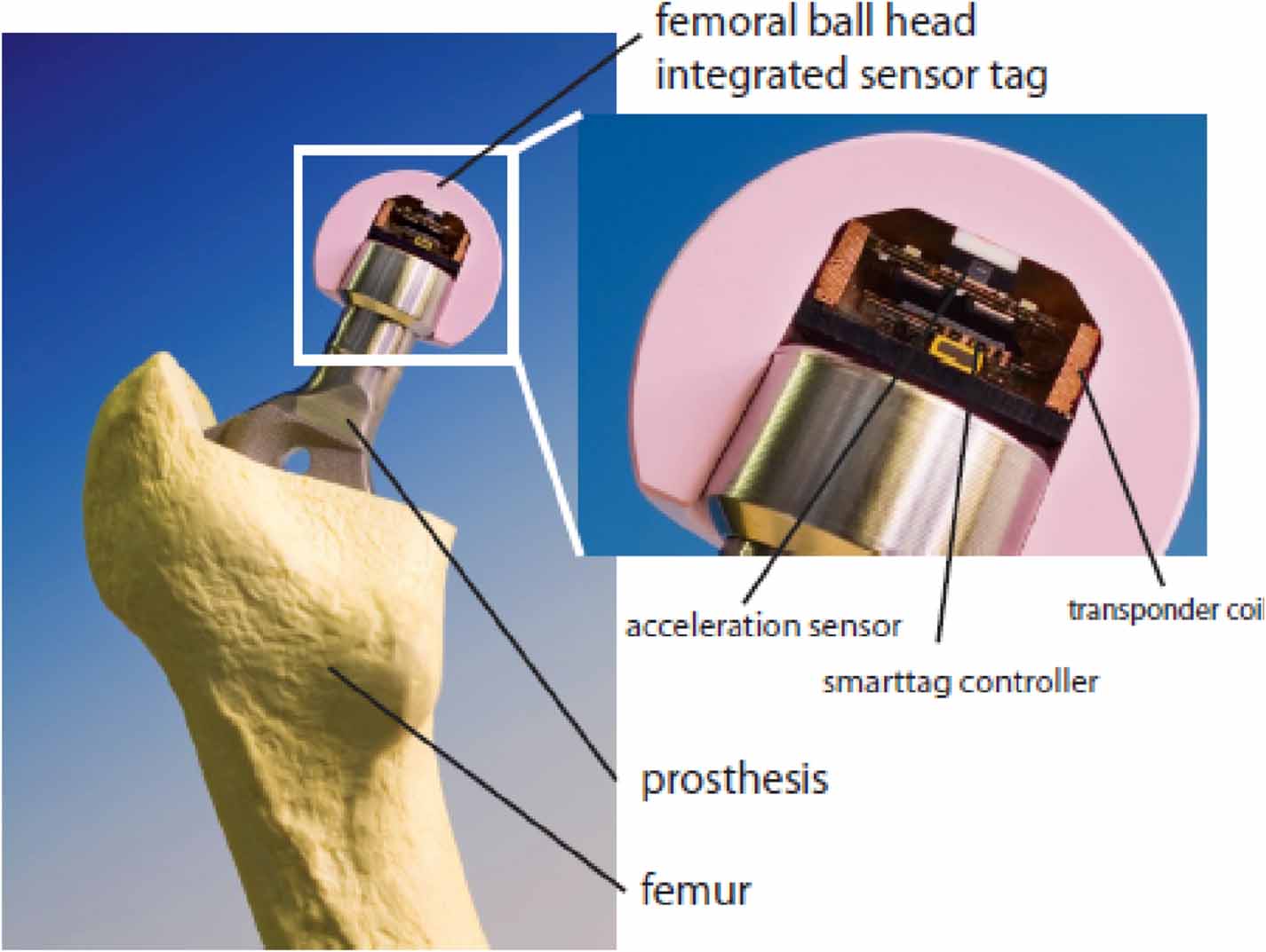 Is in vivo sensing in a total hip replacement a possibility? A review ...
