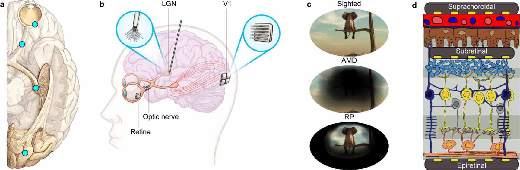 Advances in visual prostheses: engineering and biological challenges ...