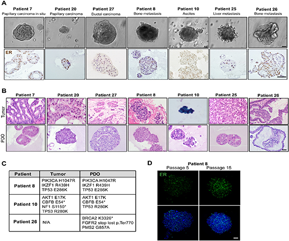 Development of bioengineered 3D patient derived breast cancer organoid ...
