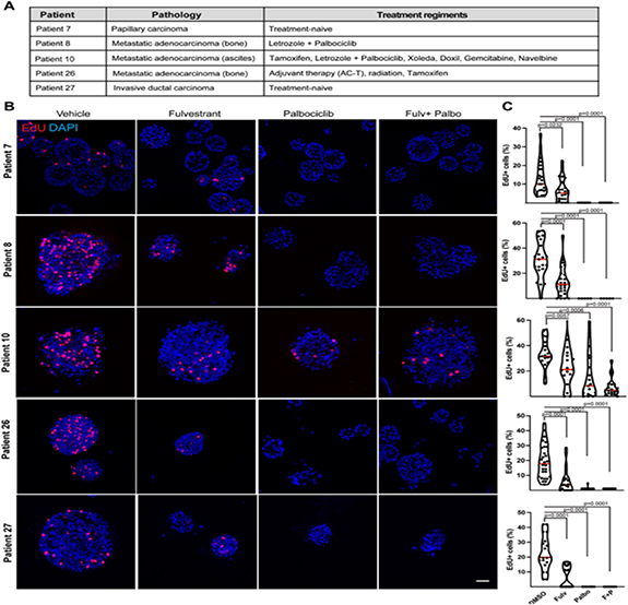 Development of bioengineered 3D patient derived breast cancer organoid ...