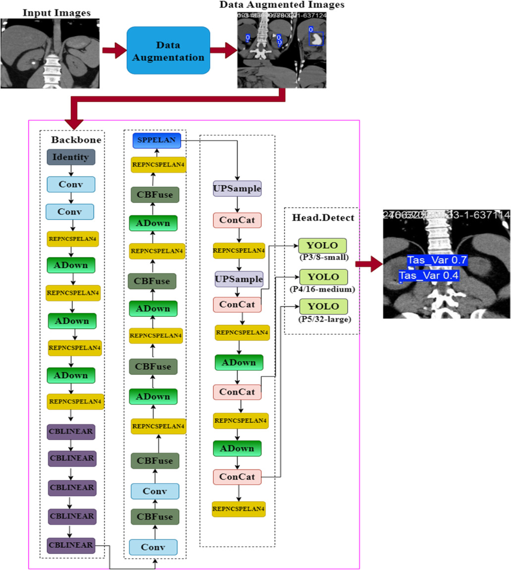 Kidney stone detection in CT scans using attention based multi-path ...