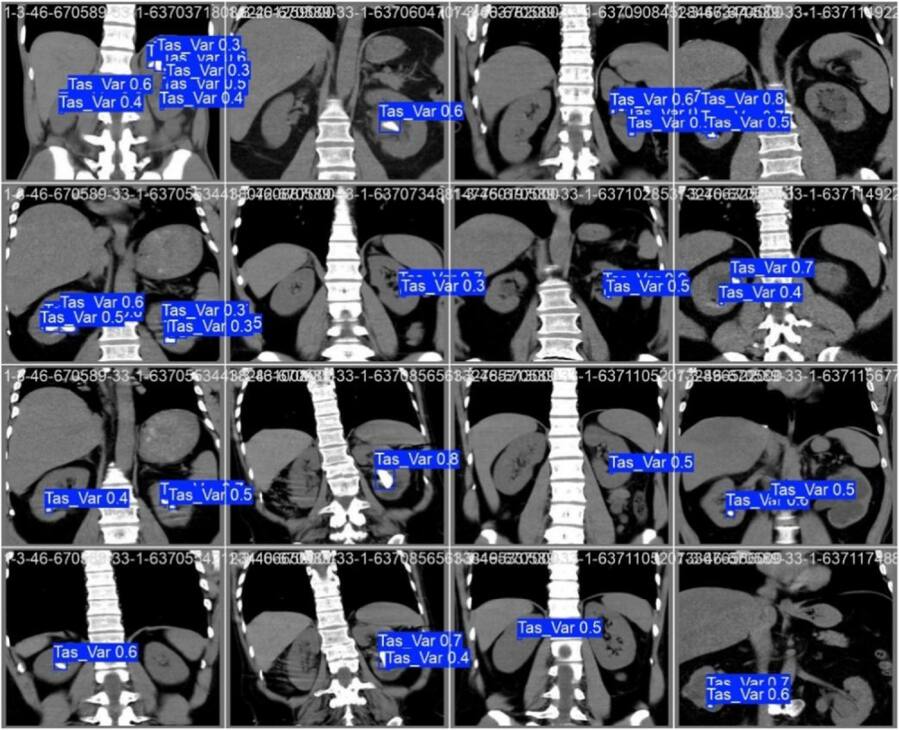 Kidney stone detection in CT scans using attention based multi-path ...