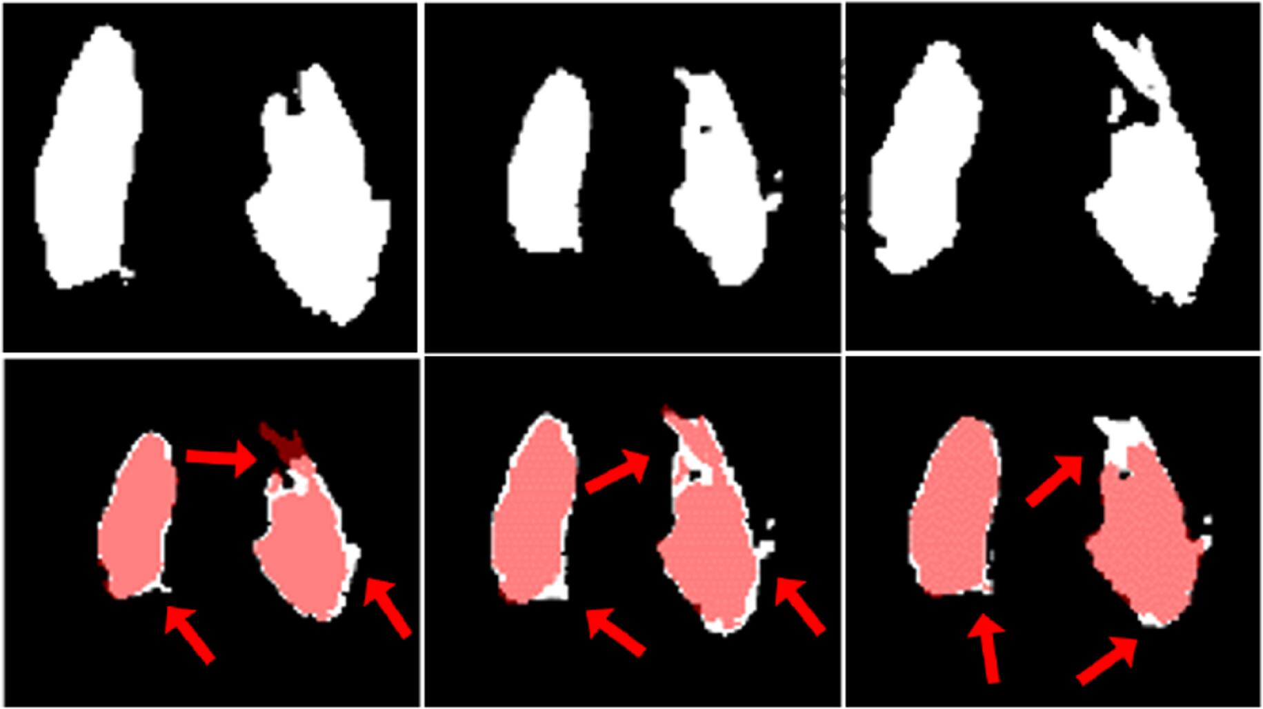 Bias correction medical image segmentation method based on multiple ...