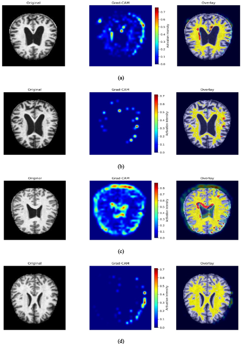 Deep learning-based multiclass dementia stage classification for ...