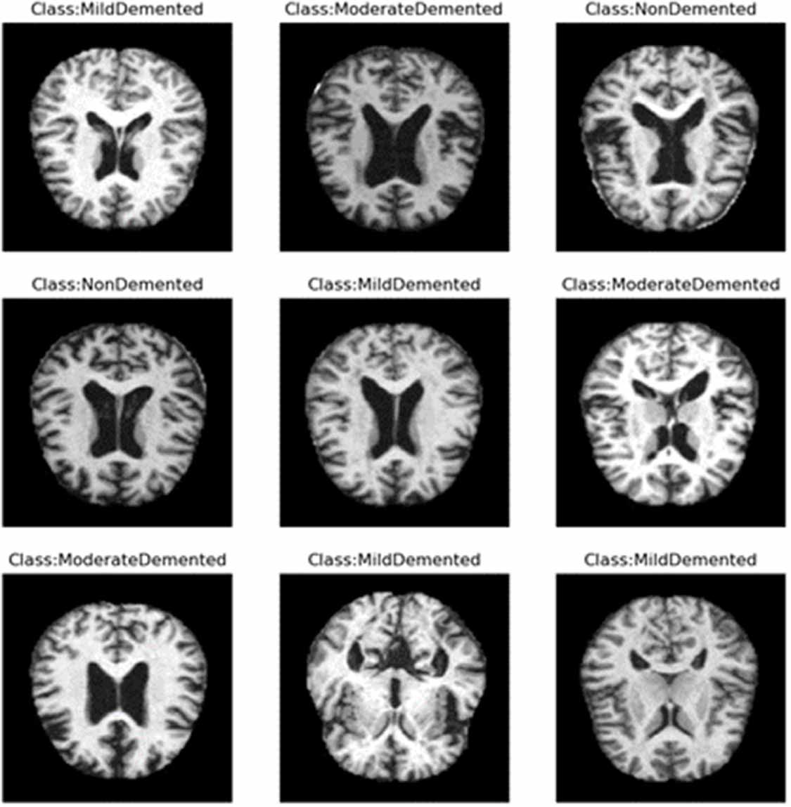 Deep learning-based multiclass dementia stage classification for ...