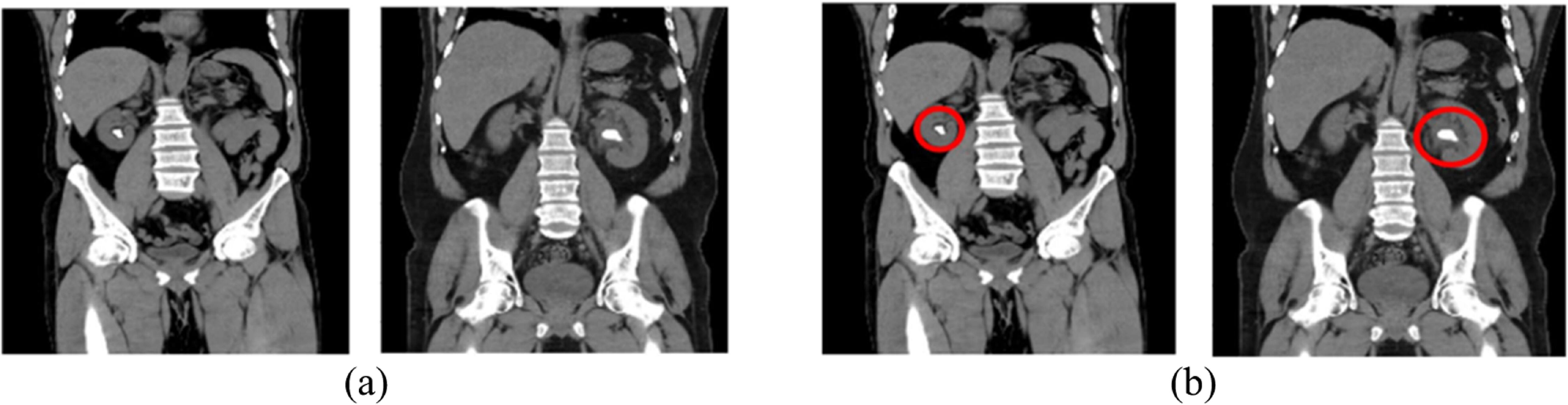 Accurate detection of kidney stones using attention-based graph models ...
