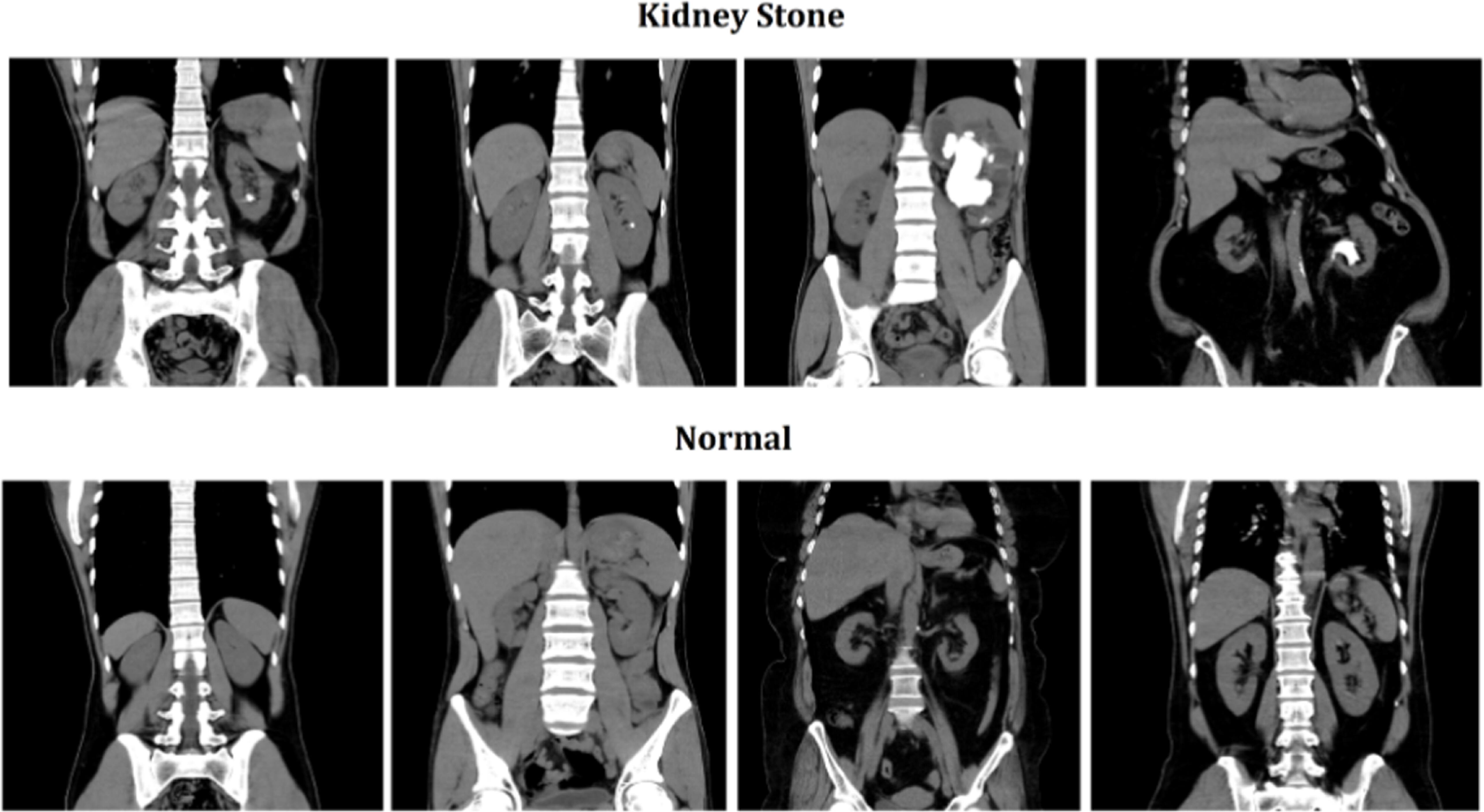 Accurate detection of kidney stones using attention-based graph models ...