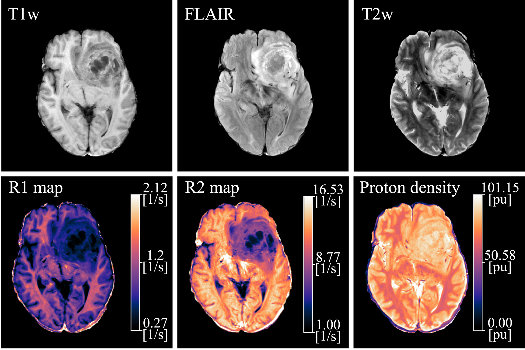 Deep learning-based detection and identification of brain tumor ...