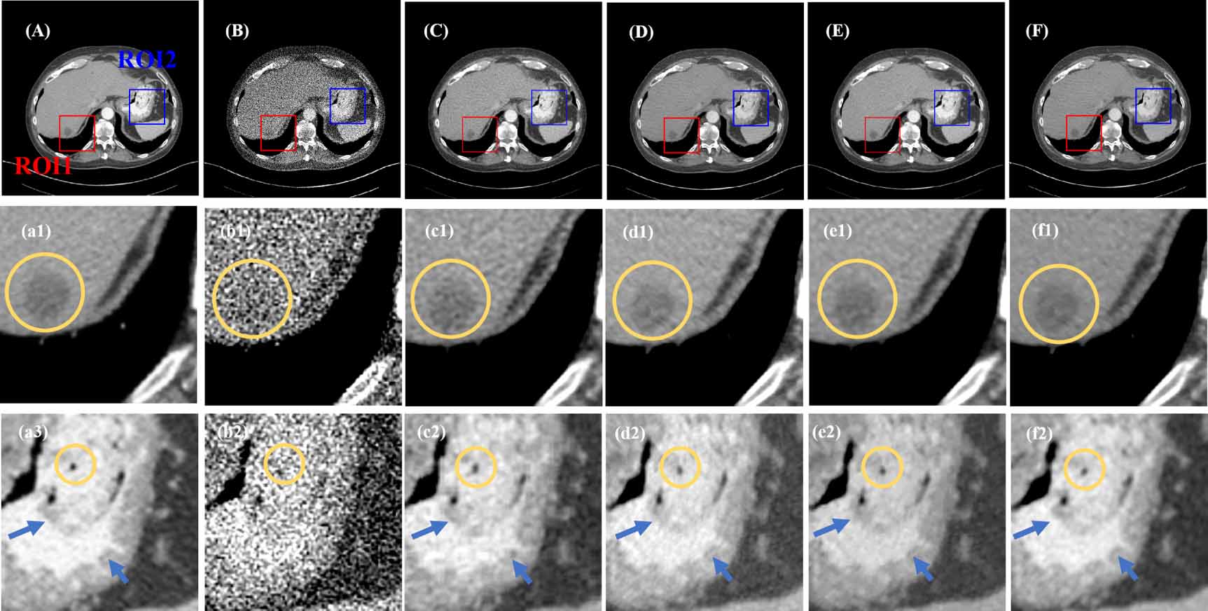 Generation model meets swin transformer for unsupervised low-dose CT ...