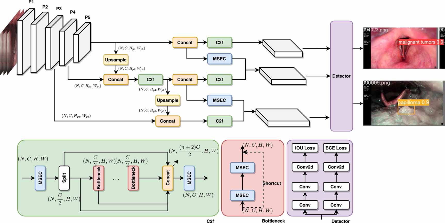 Laryngeal cancer diagnosis based on improved YOLOv8 algorithm - IOPscience