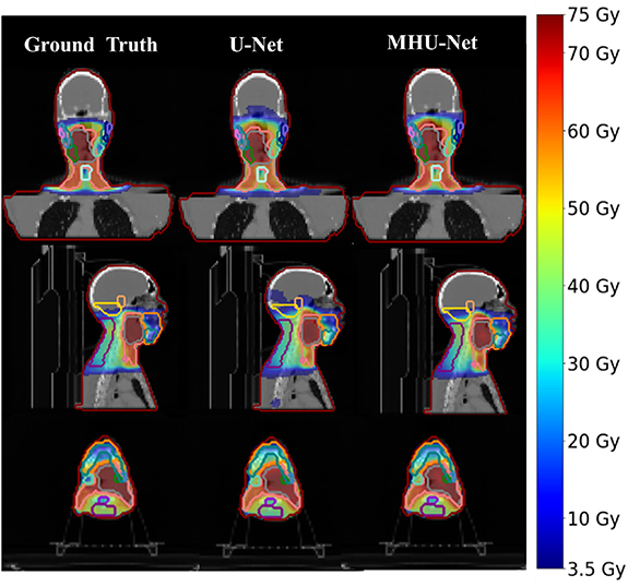 Adaptive radiotherapy dose prediction on head and neck cancer patients ...